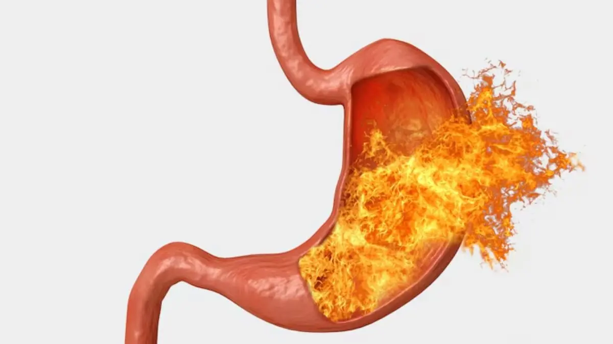 Stomach Heat: पेट में गर्मी होने से सेहत को हो सकते हैं बड़े नुकसान, जान लें इसके लक्षण, कहीं एक गलती बन न जाए खतरे की घंटी how to reduce stomach heat easily treatment and causes pet ki garmi kaise kam kare