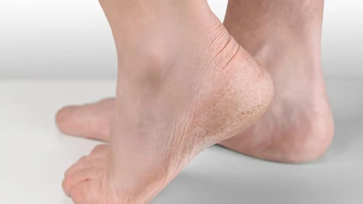 how to take care of dry feet skin home remedy