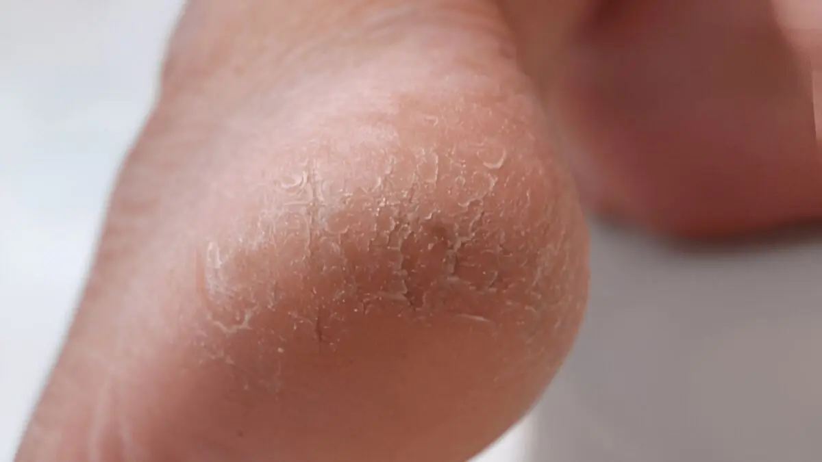 how to take care of your feet and cracked heels at home