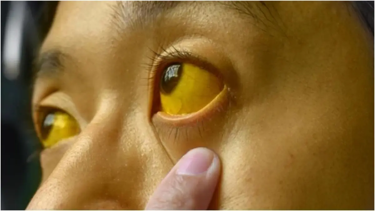 What Causes Jaundice In Adults? Know Its Causes, Symptoms And Treatment Jaundice