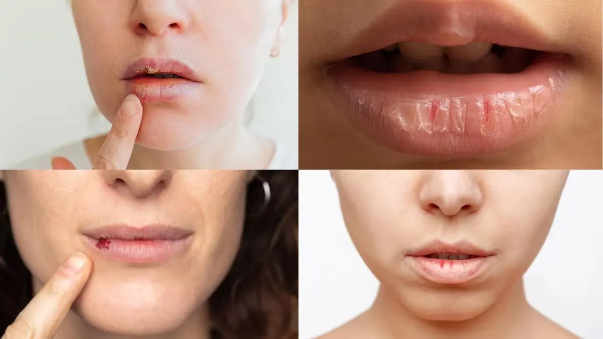 Lip Care: सर्दियों में फटे होठों को कैसे करें रेस्क्यू? अपना लें ये 5 सस्ते उपाय Lip Care
