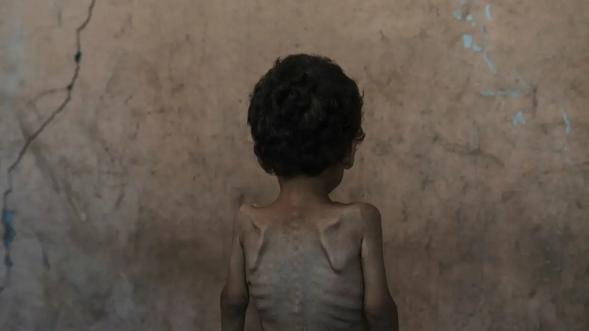 More than 54,600 Children Younger than 5 may Be Acutely Malnourished in Gaza, Study Finds