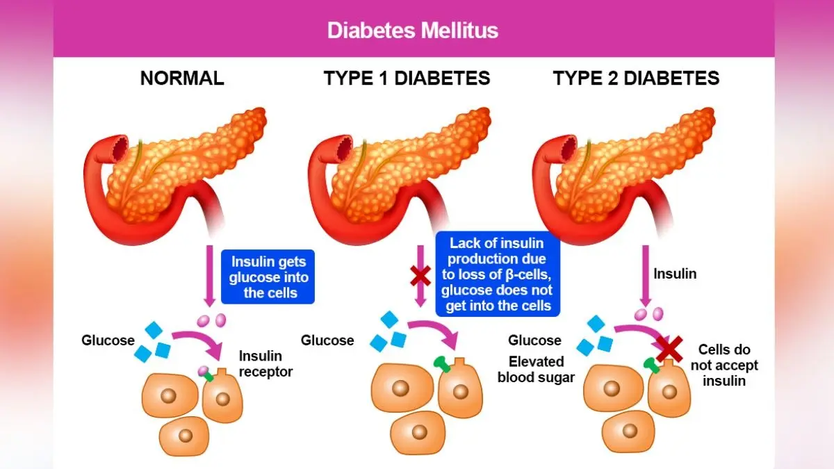 Natural Support For Type 1 Diabetes