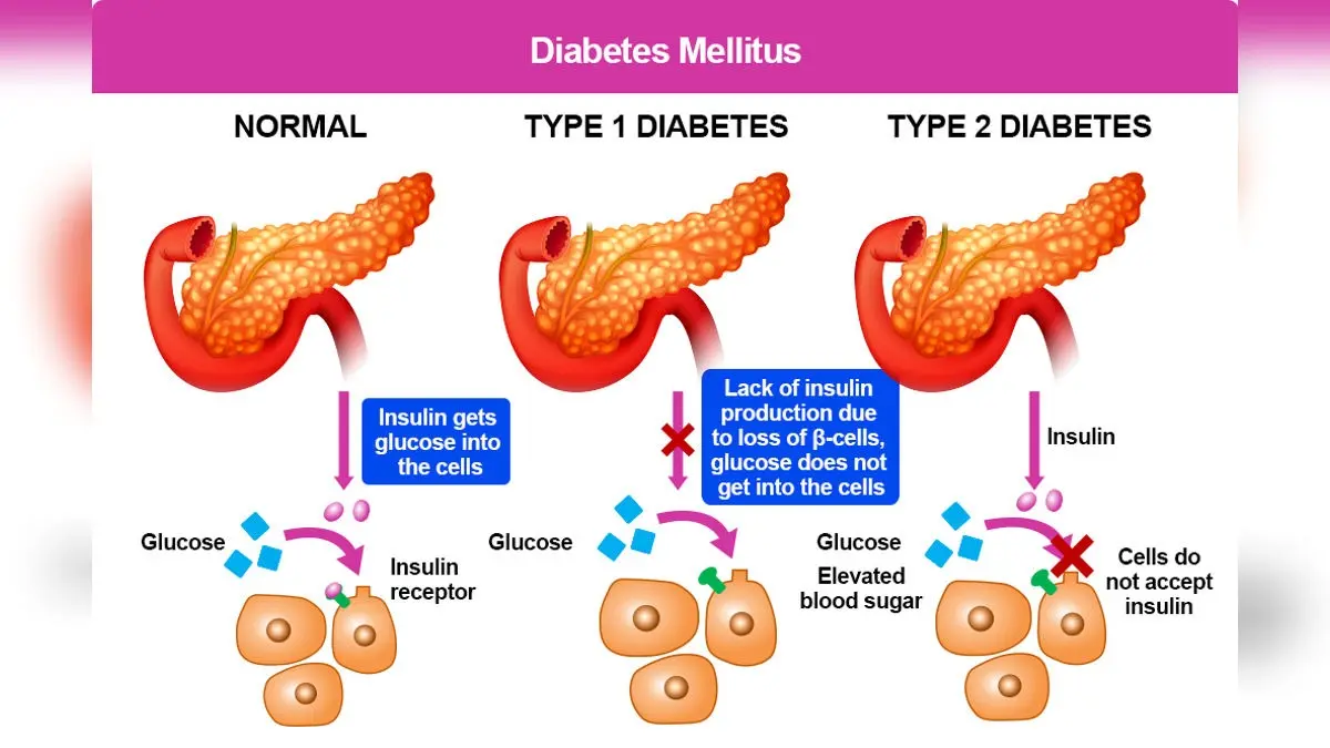 Natural Support For Type 1 Diabetes: Ayurvedic Insights By Swami Ramdev