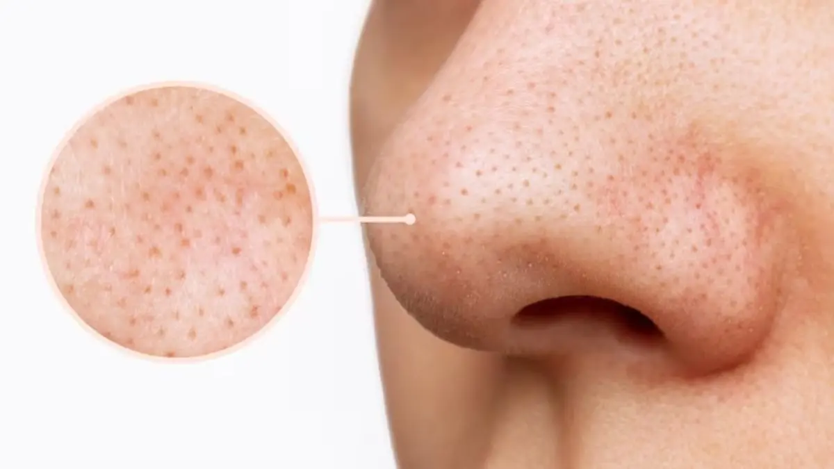 Nose Blackheads Removal Tips