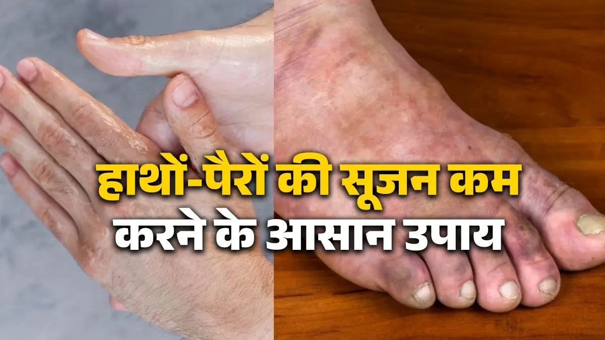 Swollen Fingers: सर्दी में हाथों-पैरों की उंगलियां में क्यों आती है सूजन? जानें कारण और बचाव के उपाय ollen-fingers-and-toes-in-winter-causes-symptoms-treatment-and-home-remedies