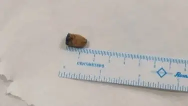 Pen Cap Stuck In Man's Lungs For 21 Years, Removed By Hyderabad Doctors Pen Cap Stuck In Man's Lungs For 21 Years, Removed By Hyderabad Doctors