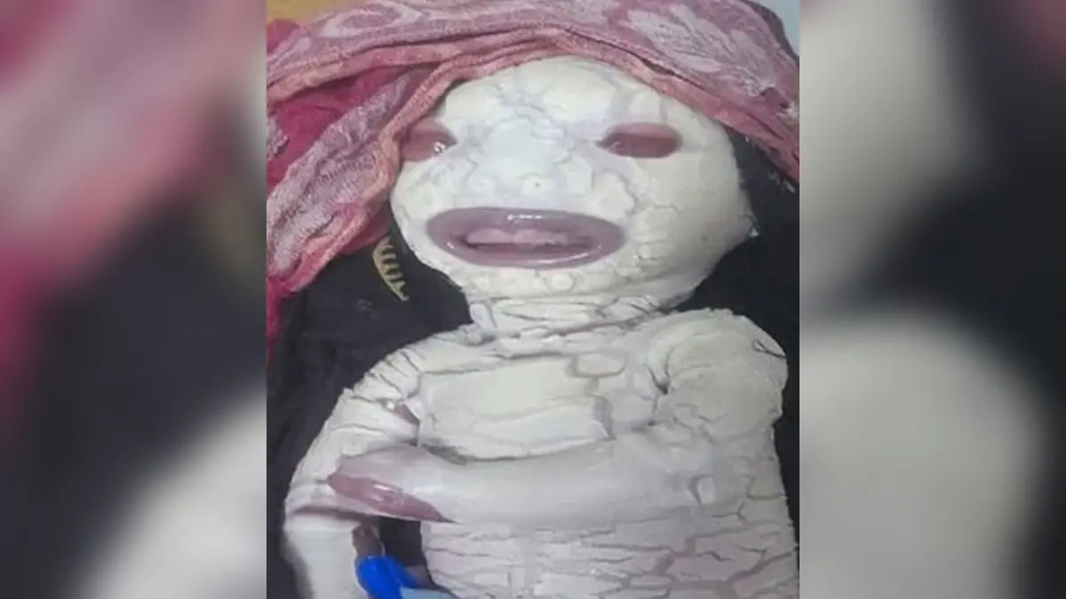 Premature Baby Born with Rare Genetic Disorder in Madhya Pradesh