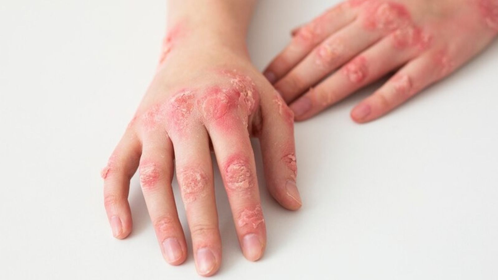 Psoriasis