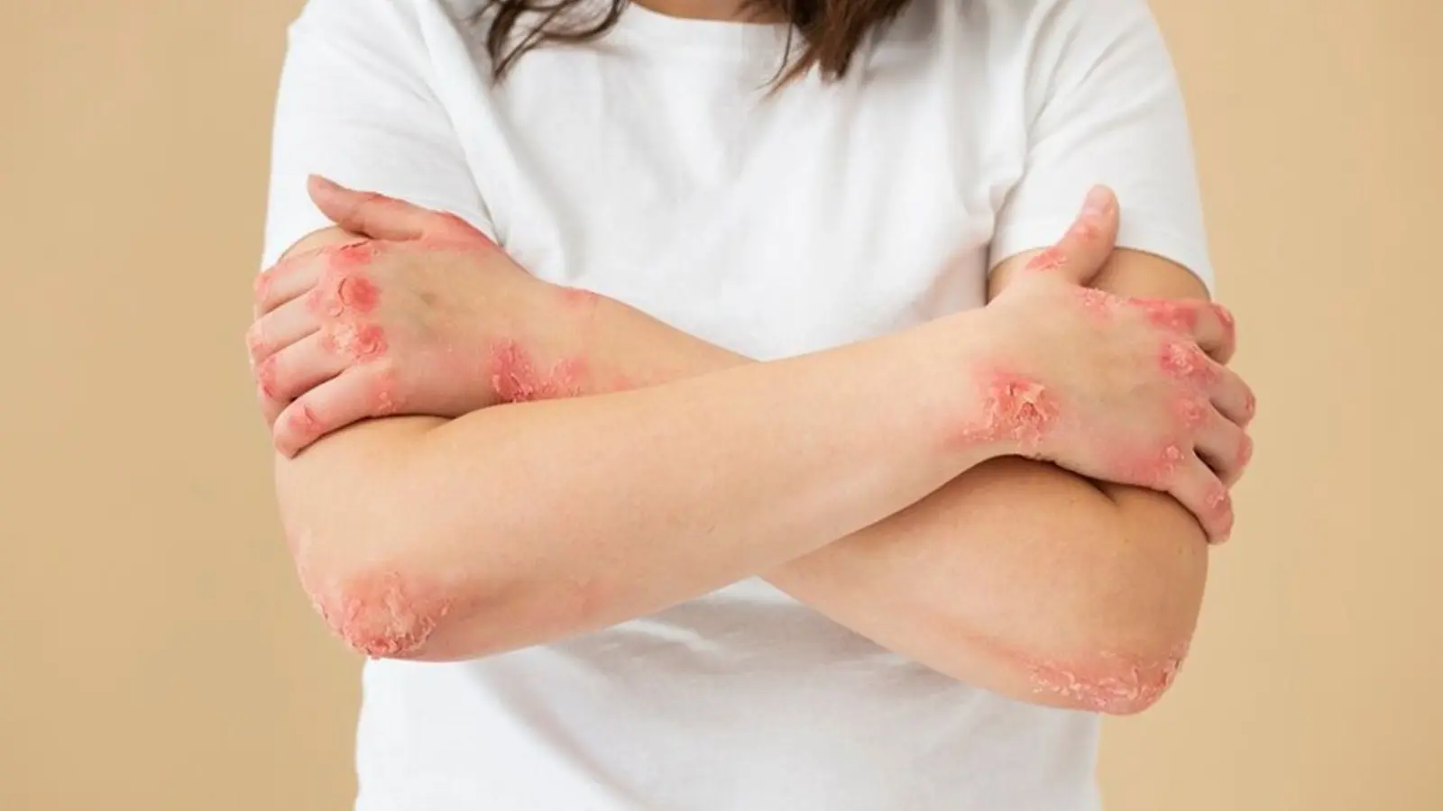 Psoriasis