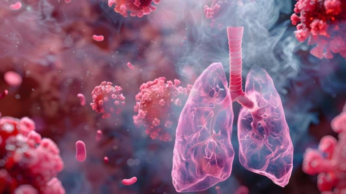 Representational image of TB