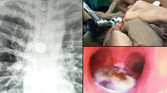 BHU Doctors Remove 25 Paise Coin from Patient's Windpipe