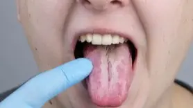 What Is Oral Thrush? Causes, Risk Factors Of Fungal Mouth Infection Oral Thrush