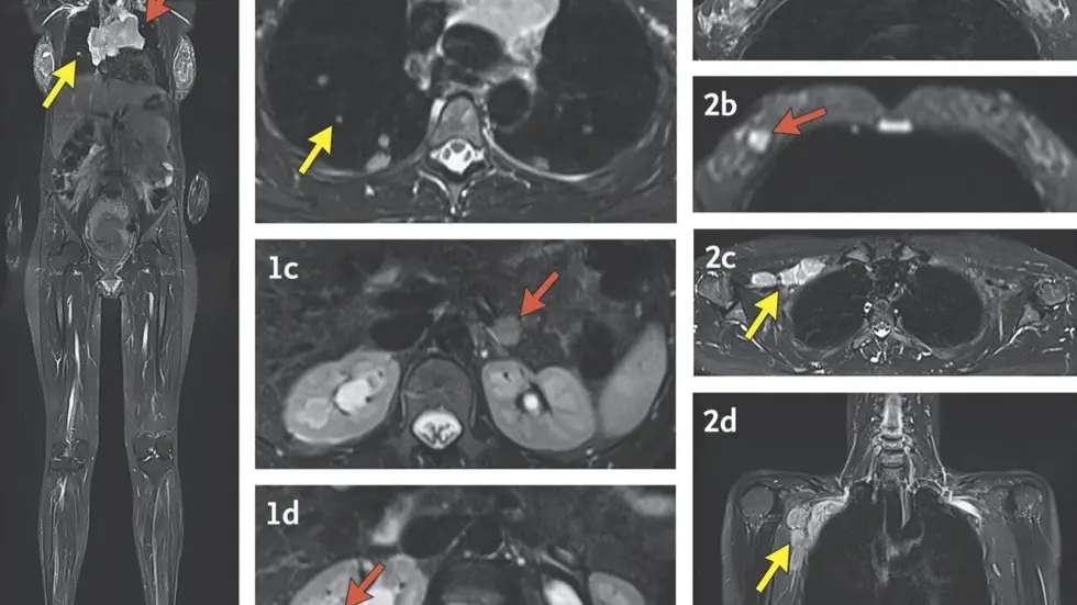 Prenatal Blood Test Can Sometimes Hint At Cancer In Moms-To-Be, Study These MRI images with arrows indicating cancer were made during a study by researchers at the National Institutes of Health and published Wednesday, Dec. 4, 2024, in the New England Journal of Medicine.