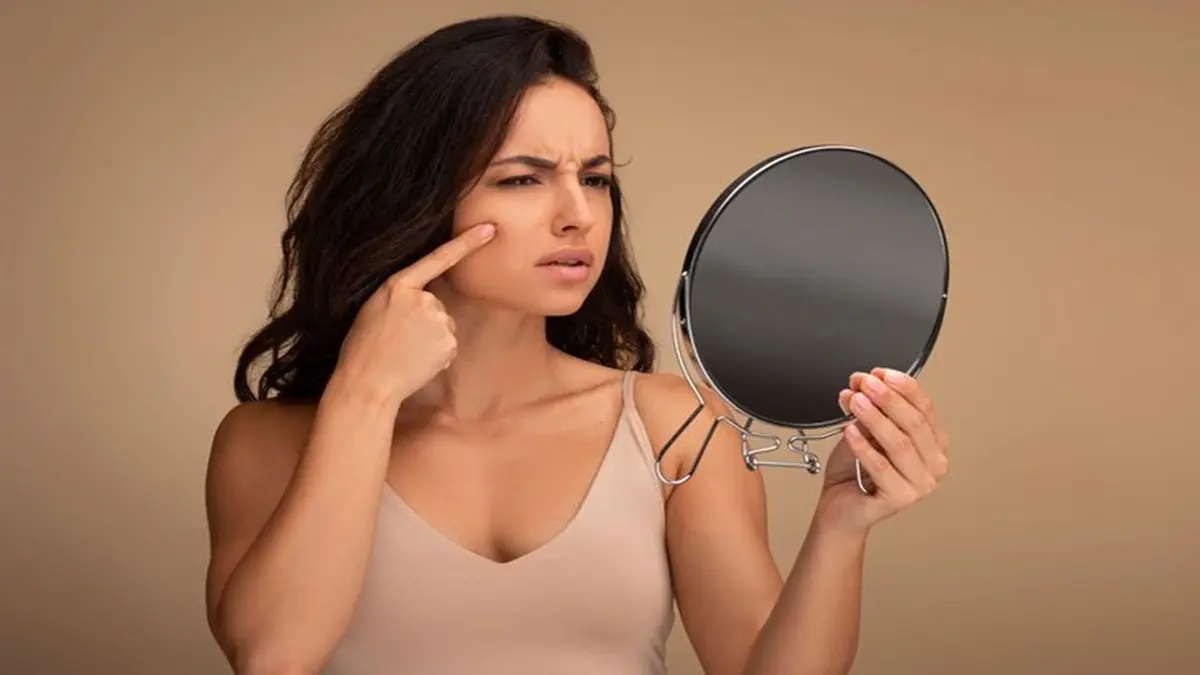 Top 5 Foods to Prevent Acne and Inflammation