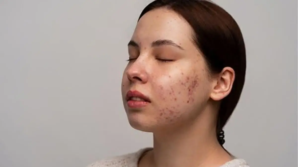 Tretinoin Cream 0.05 over the counter Hacks for Faster Results 2026 UK ,USA Dermatologist’s Guide Tretinoin Cream 0.05 over the counter Hacks for Faster Results 2026 UK ,USA Dermatologist’s Guide