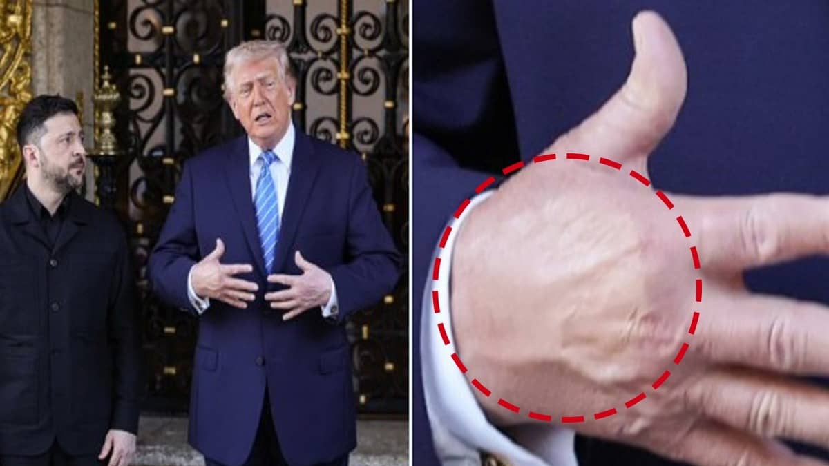 Trump Spotted With 'Visible Makeup Patch' on Hand, Fueling Health Speculation After Zelenskyy Meet 