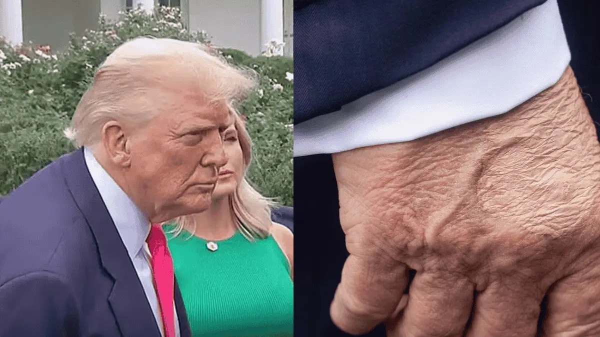 Trump’s Hand Bruise Covered with Makeup