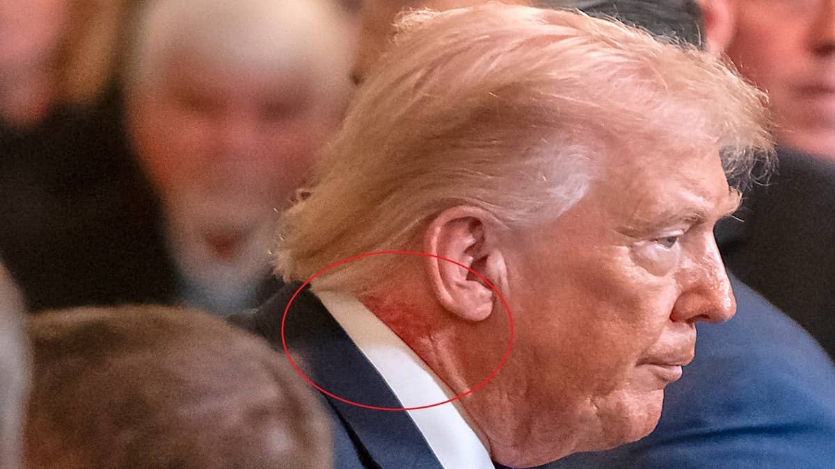 Trump’s Neck Spot Mystery Solved? White House Physician Links Redness To Skin Cream