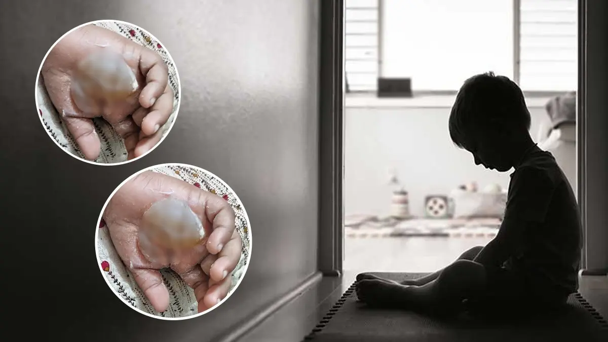 Tuition Teacher Burns 8 YearOlds Palms