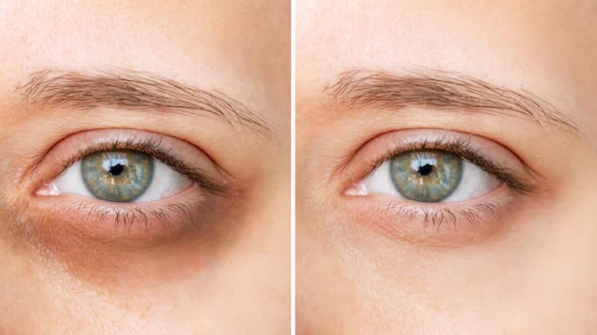 Under Eye Care Tips
