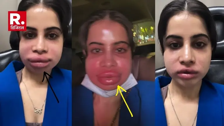 अरे! Urfi Javed को ये क्या हो गया? बुरी तरह से सूजा एक्ट्रेस का चेहरा, वीडियो देख फैंस को हुई चिंता Urfi Javed Lip Filler