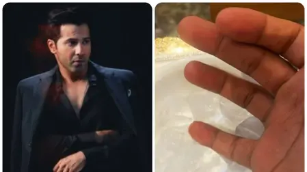 Varun Dhawan Injured