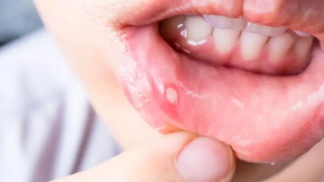 What Causes Mouth Ulcers And How Long Do They Last?