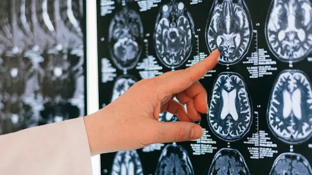 What Is Brain Ageing?