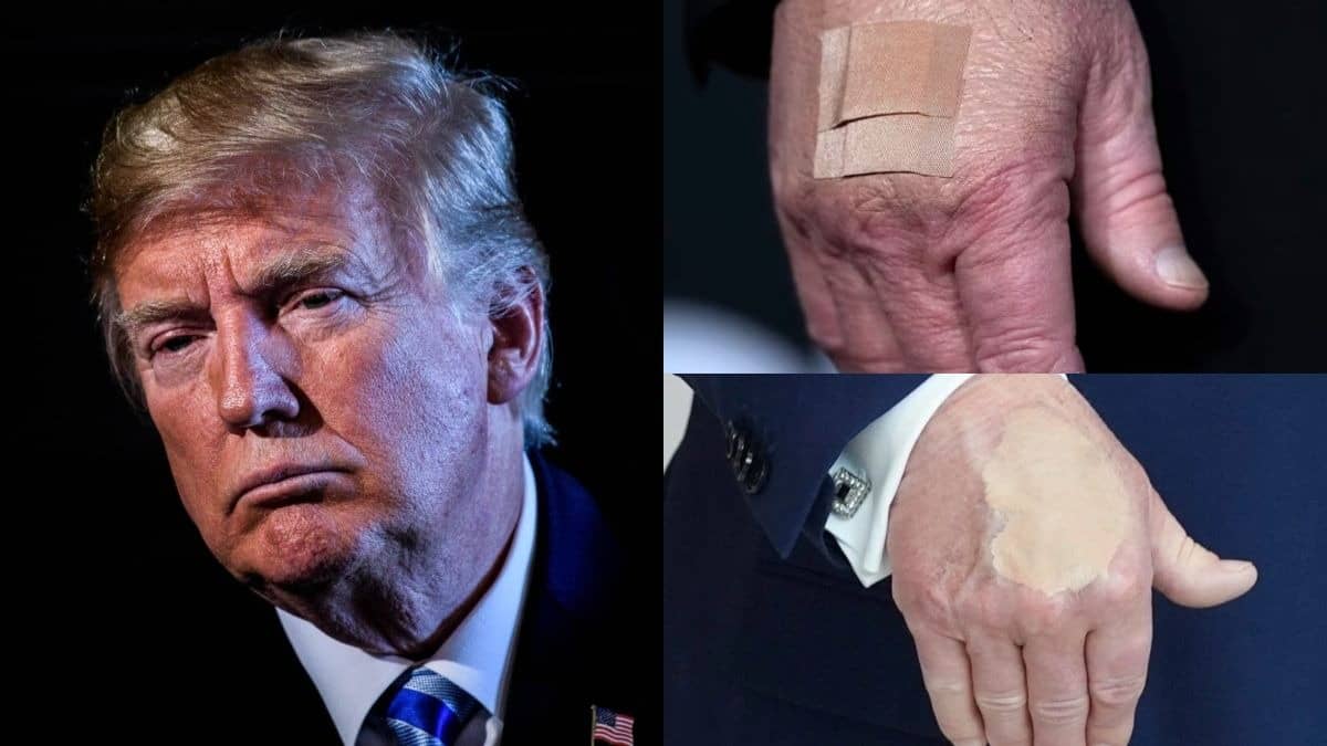What Is The Mystery Behind Bandages & Bruises on Trump's Hands?