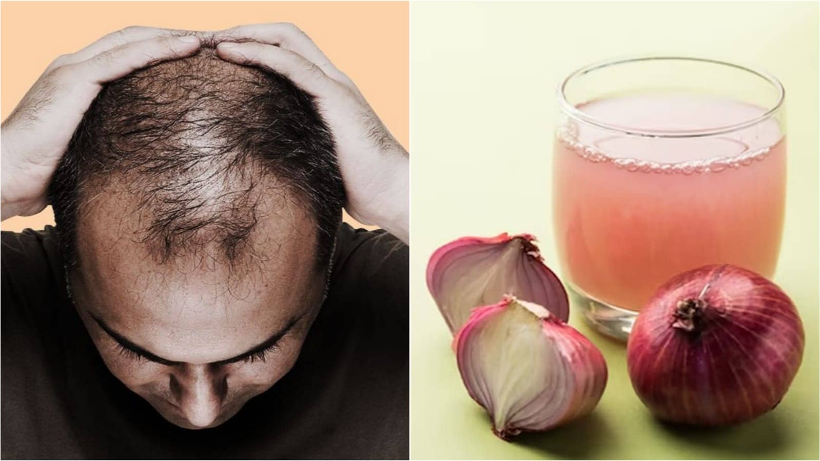 Onion Juice Therapy Natural Treatment For Dandruff, Hair Loss, A