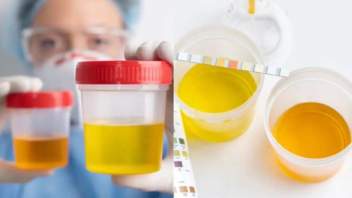 why urine colour changes know reasons symptoms signs of kidney damage health tips