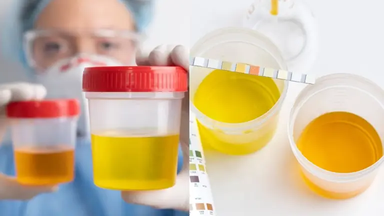 Urine Colour: यूरिन के रंग में बदलाव आपकी सेहत का बताता है हाल, इन संकेतों को कभी ना करें नजरअंदाज why urine colour changes know reasons symptoms signs of kidney damage health tips