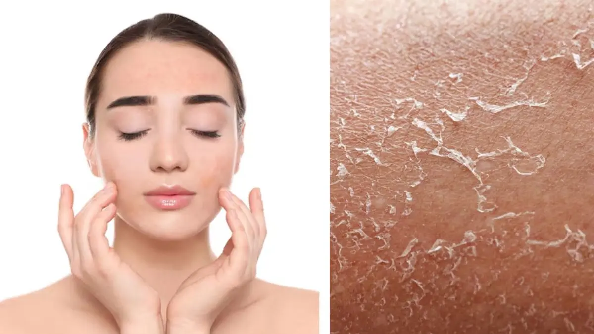 Winter Dry Skin Care Tips