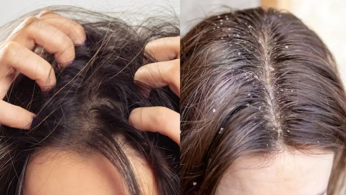 winter hair care tips to prevent itchy scalp dandruff problem and get rod of lice easily balon ki dekhbhal kaise kare
