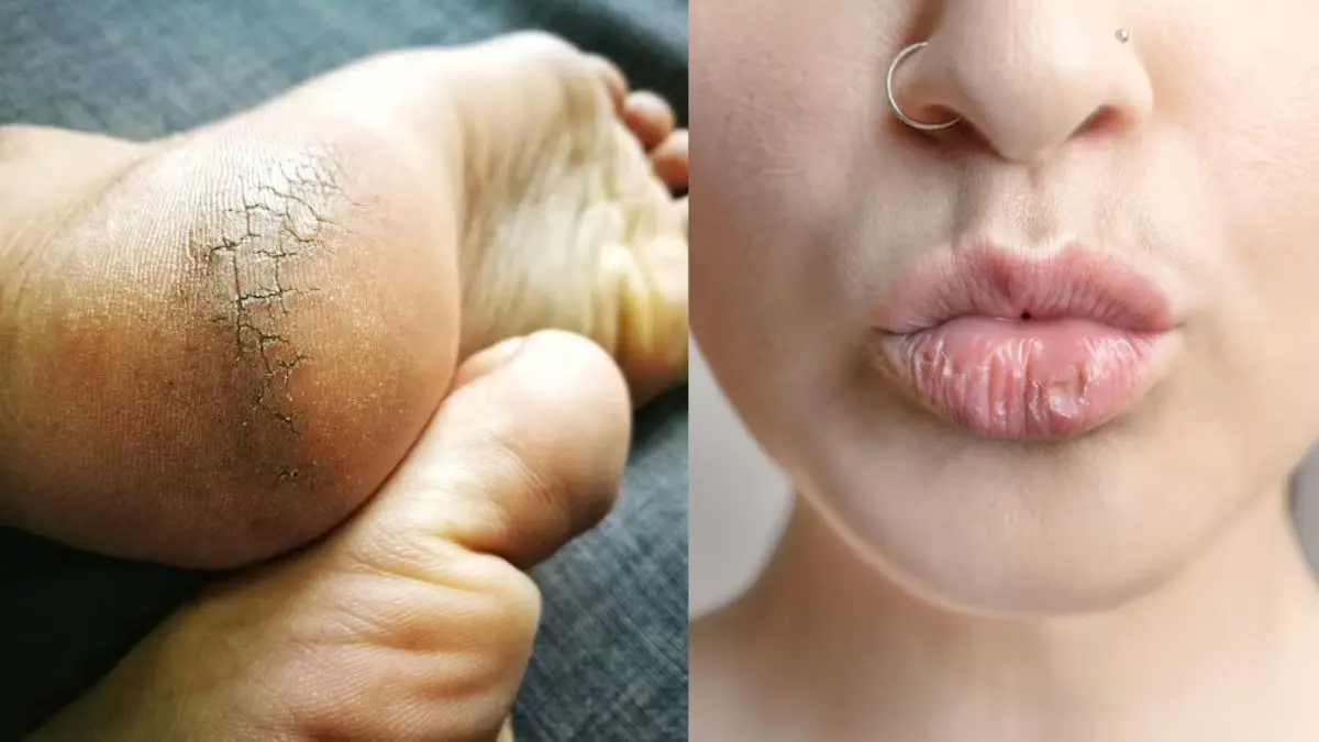 Winter Skin Care varun mudra  