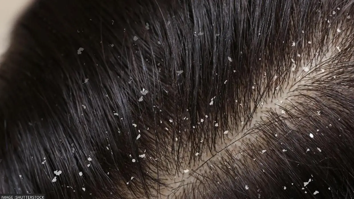 Dandruff Removing Tips