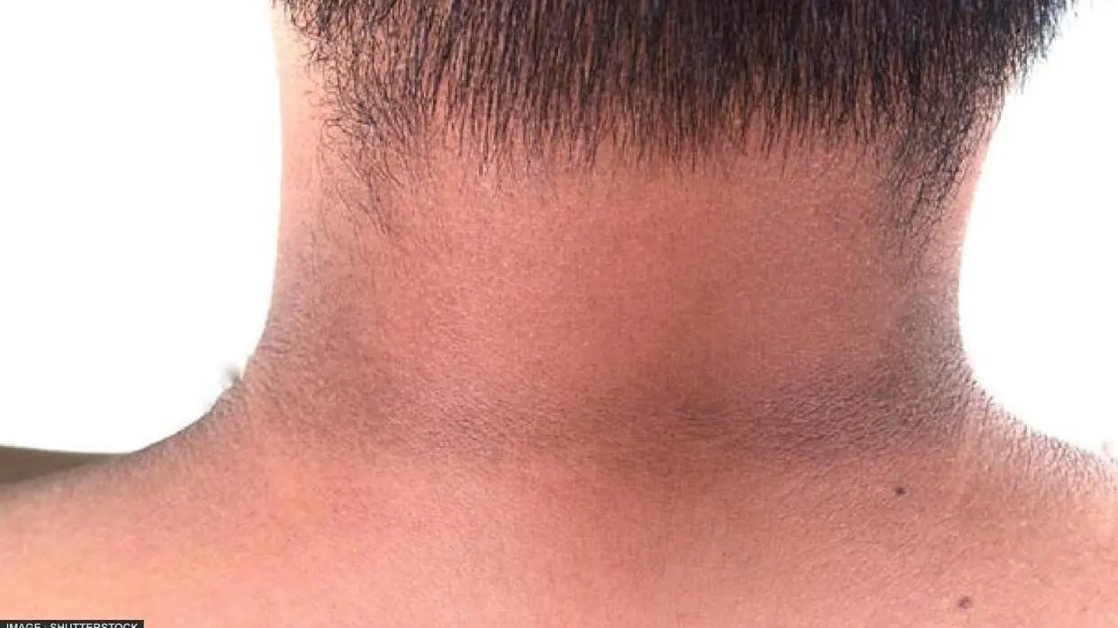 Home Remedies To Remove Neck Tanning