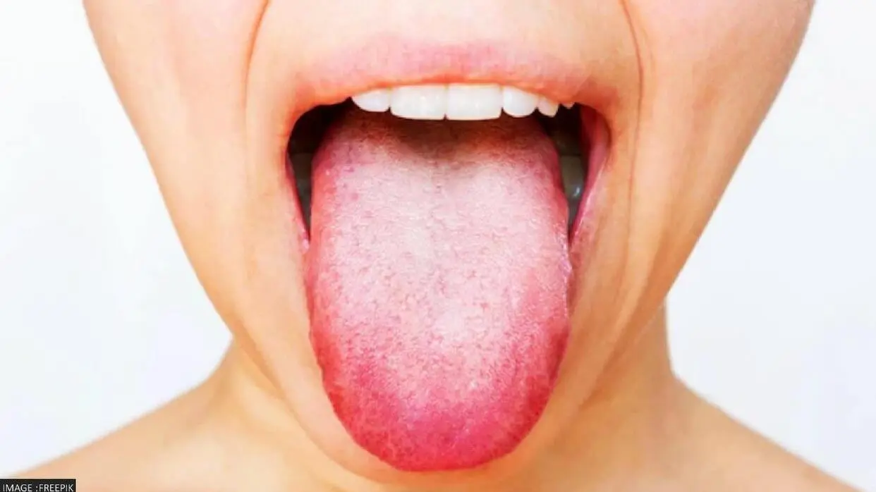 Cause Of White Tongue