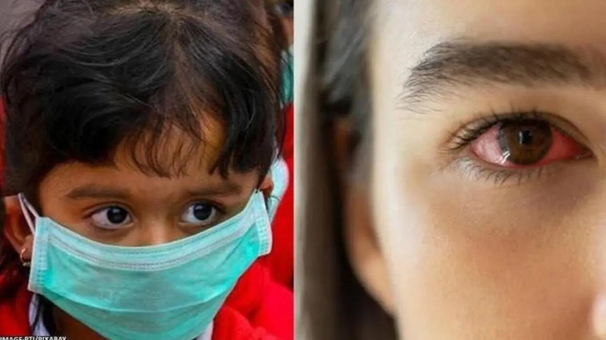 Eye Flu In Children