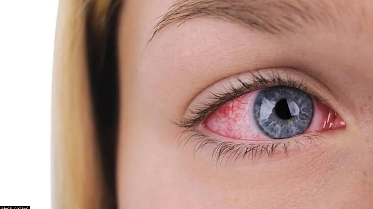 Applying Saliva on Eyes Treat Eye Flu