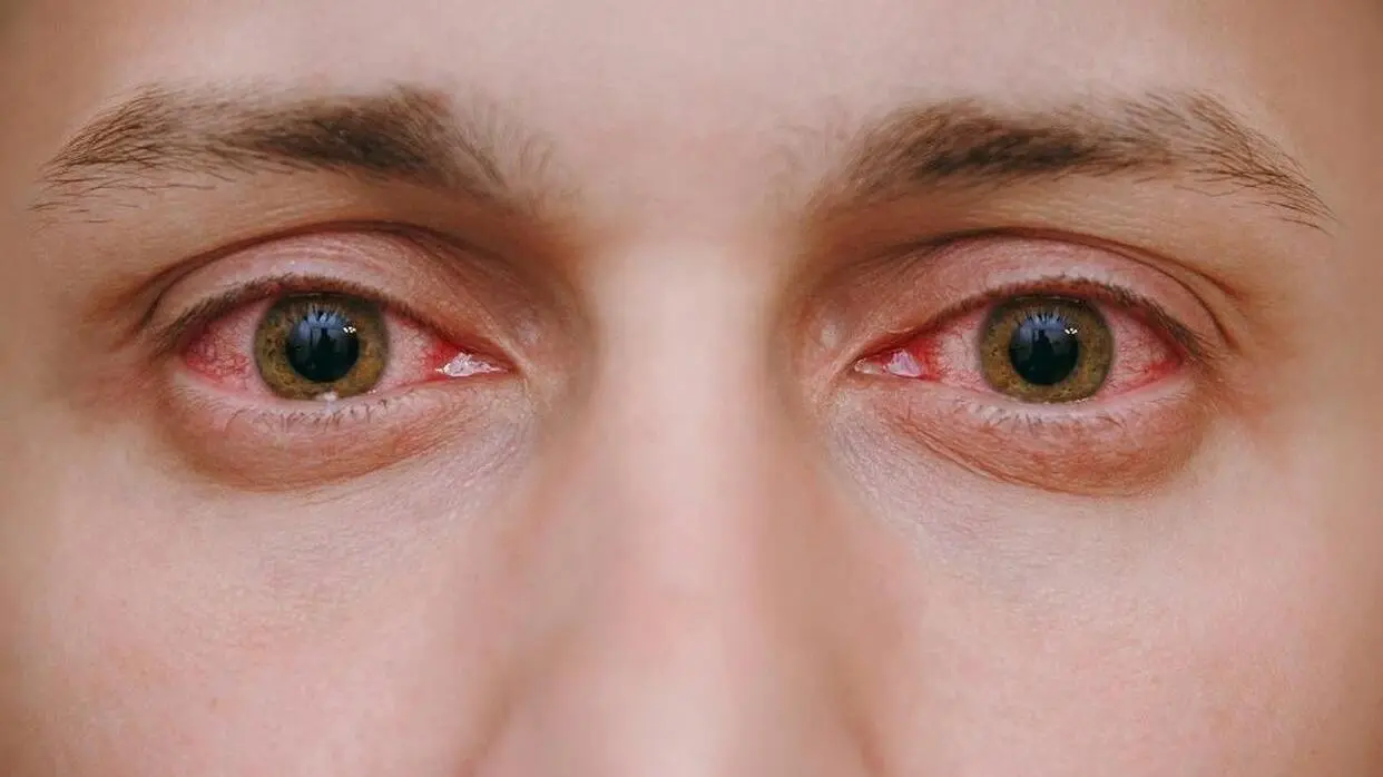 जानें आई फ्लू से जुड़ी सभी जानकारी (फोटो: shutterstock)