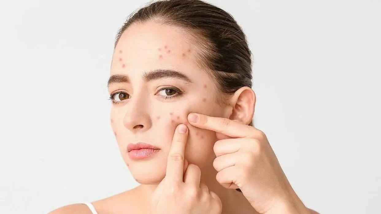 चेहरे के फोड़े-फुंसियों को कम करेंगे नीम के ये असरदार फेस पैक (फोटो : shutterstock)