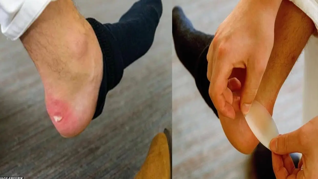 शूट बाइट की समस्या से पाएं राहत