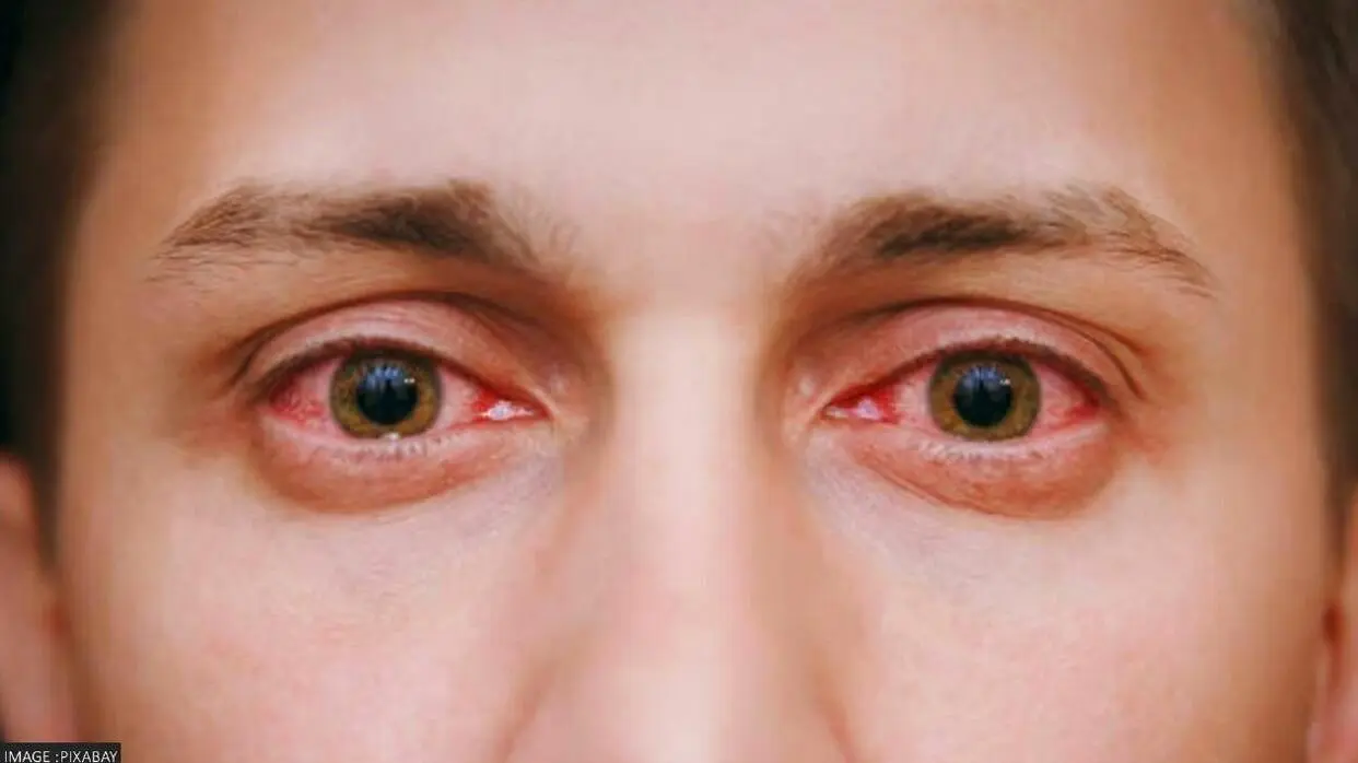 Eye Flu Ke Symptoms Dikhne Par Kya kare