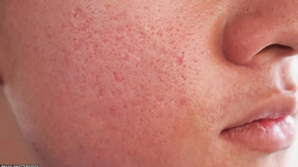 ओपन पोर्स के लिए टिप्स (फोटो : Shutterstock)