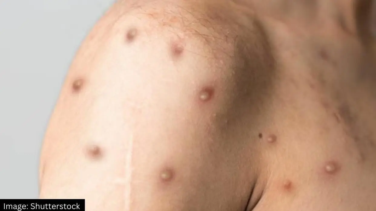 Chicken Pox New Variant Clad 9