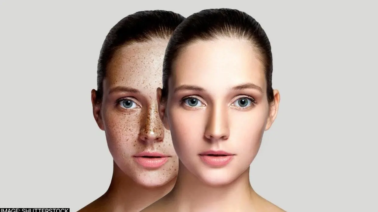पिगमेंटेशन दूर करने के उपाय (फोटो : Shutterstock)