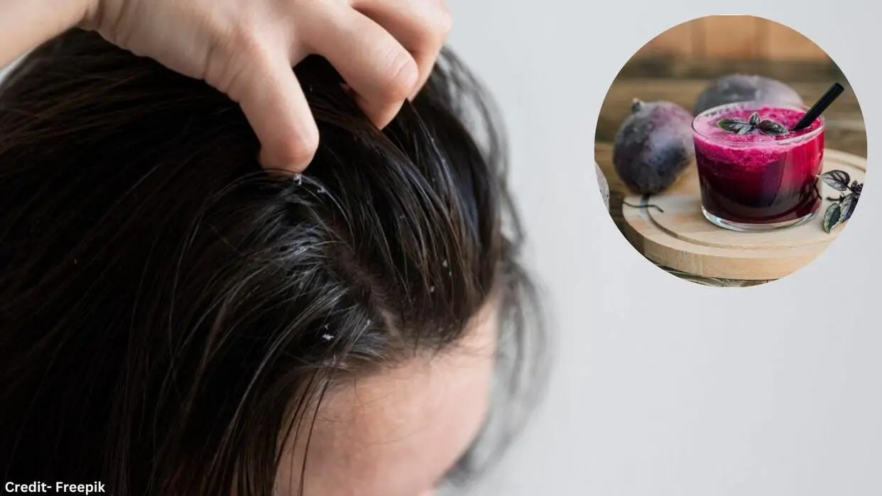 Beetroot Peels To Treat Dandruff Tips
image- freepik