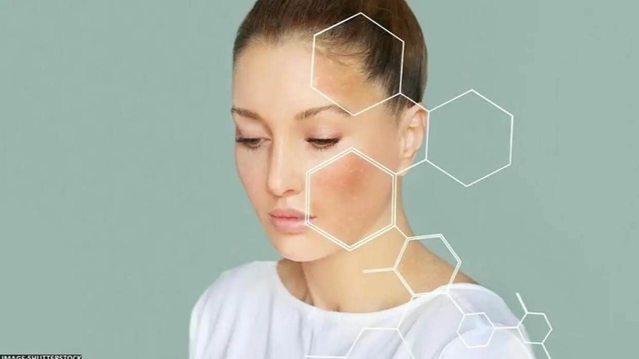 पिगमेंटेशन की समस्या ऐसे करें दूर (फोटो : Shutterstock)